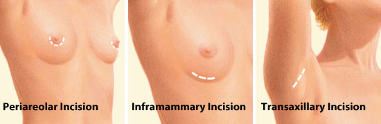 Breast Incision Type